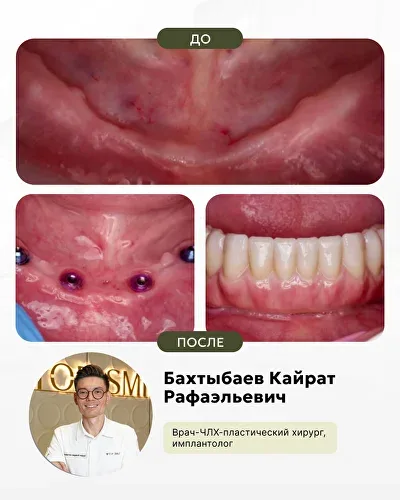 Работы нашего ведущего хирурга-имплантолога, фото 1