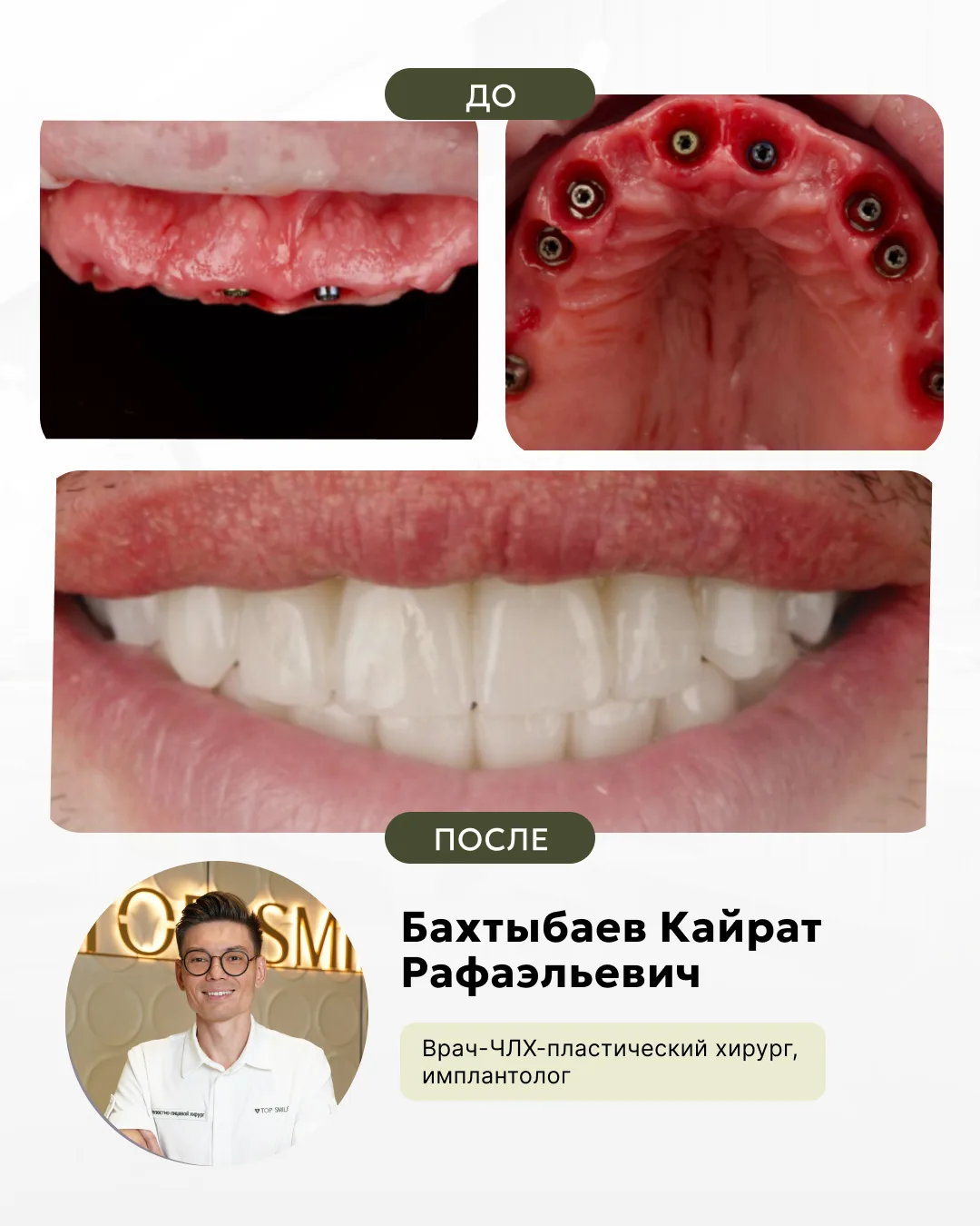 Имплантация all-on-6, фото 2